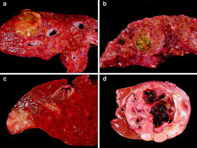Major And Minor Risk Factors of Hepatocellular Carcinoma