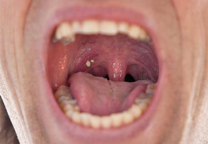 Tonsil stones