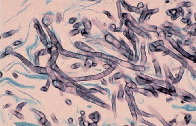 Aspergillosis