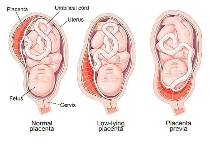 Types of placenta