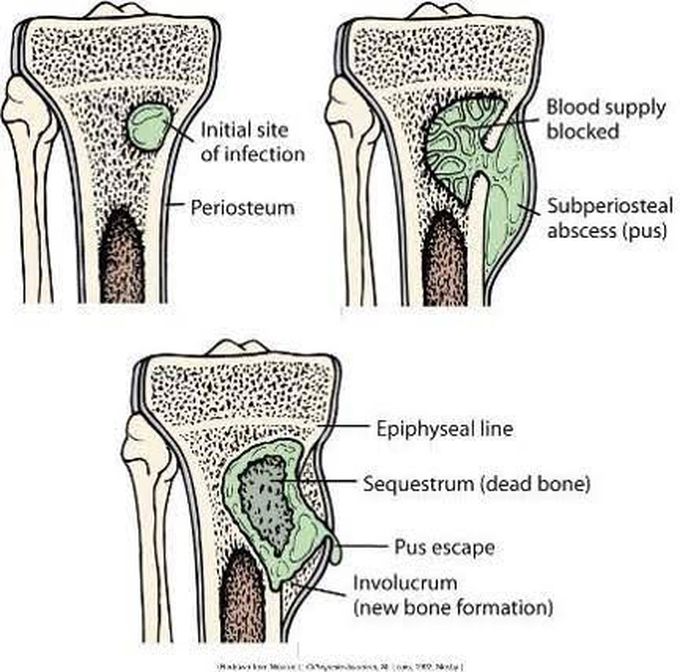 Sequestrum and Involucrum