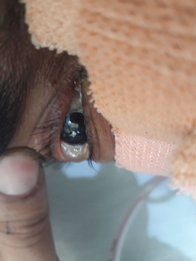 Scleral bulge!!!