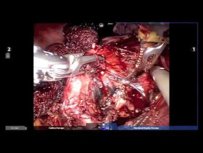 Robotic Patch Repair of the Right Main Bronchus After Removal of a Bronchogenic Cyst