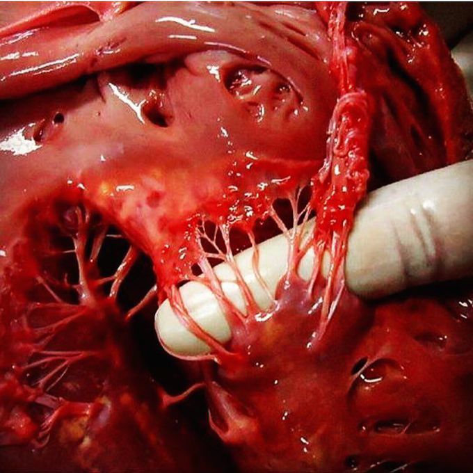 Papillary Muscles