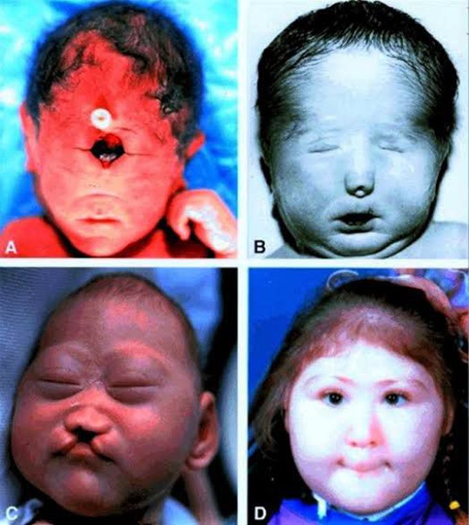 Nonsyndromic holoprosencephaly