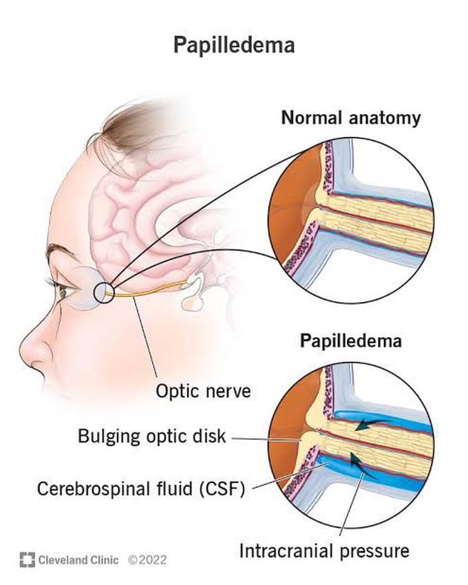 Causes of papilledema