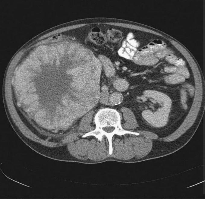 Giant Renal Oncocytoma