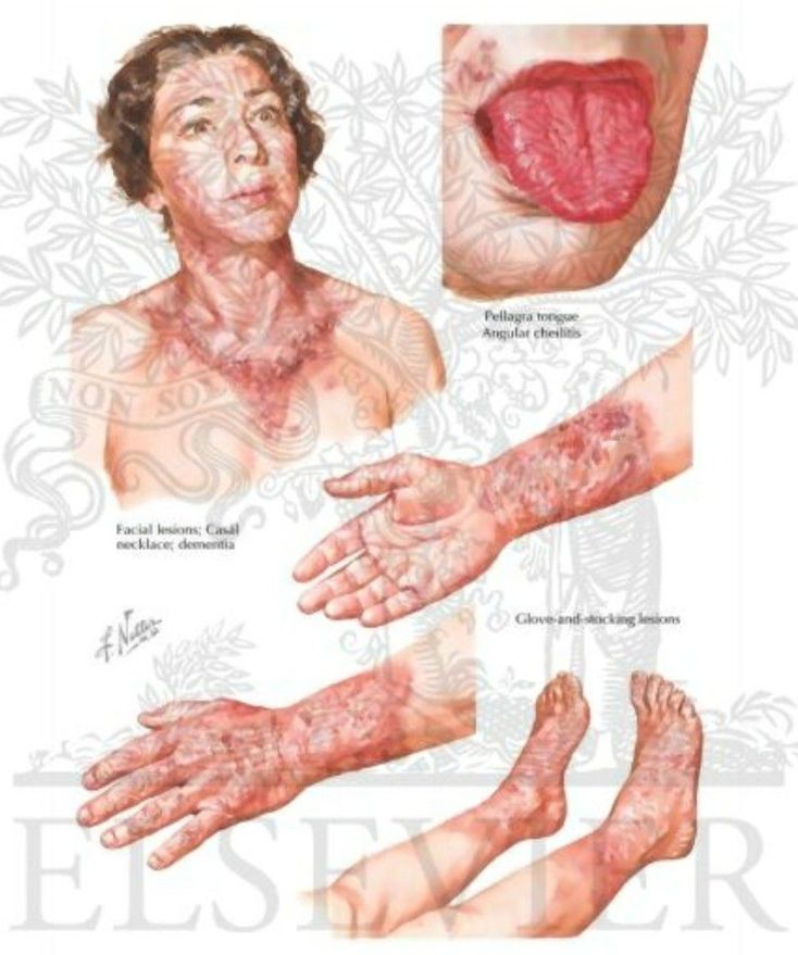 niacin deficiency tongue