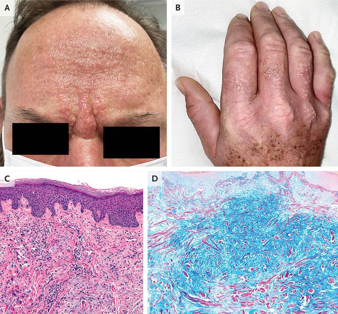 Scleromyxedema