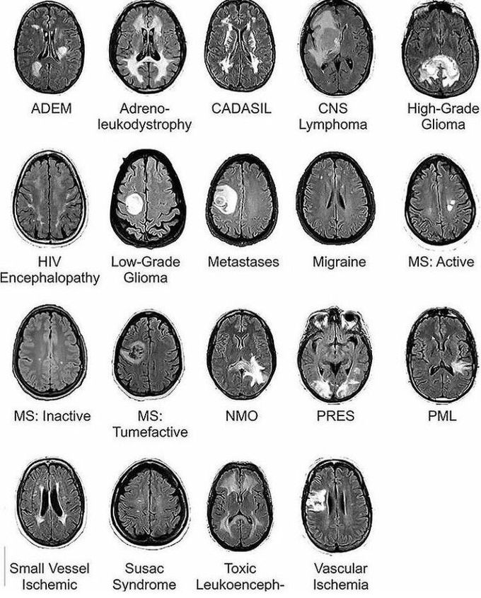 MRI of brain in different diseases