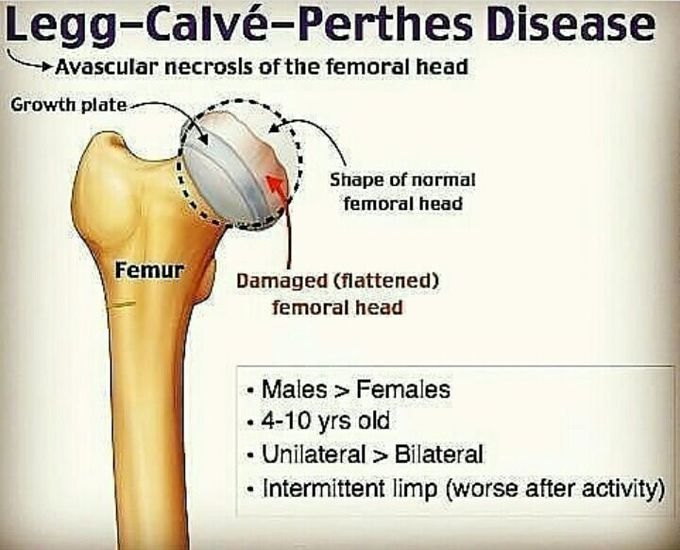 Legg _ calve _ perthes Disease