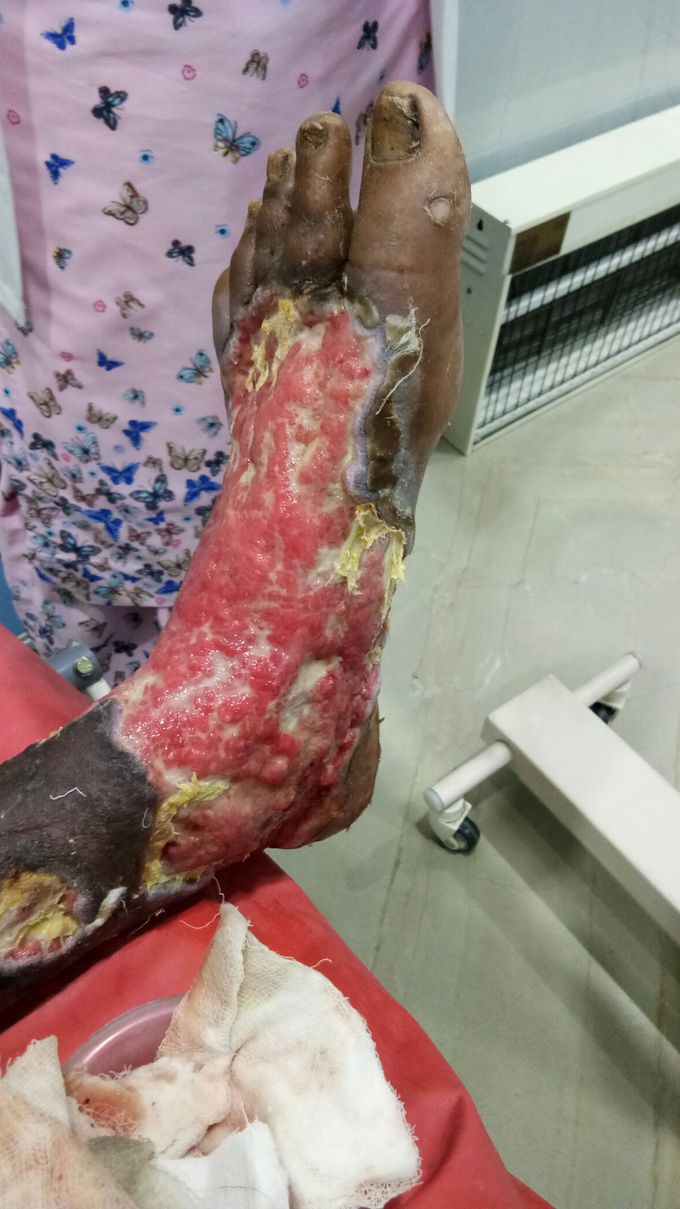 Tissue necrosis