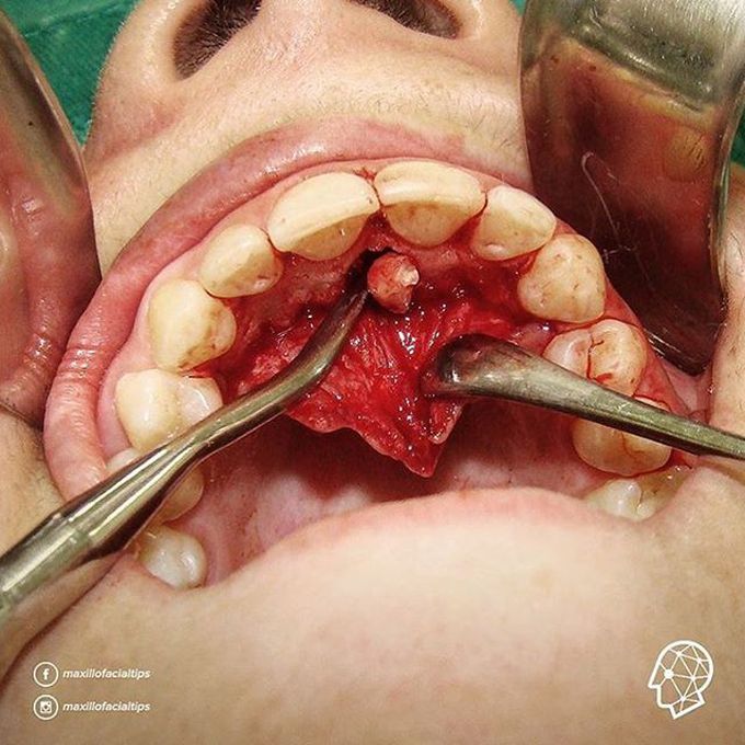 Palatal Flap