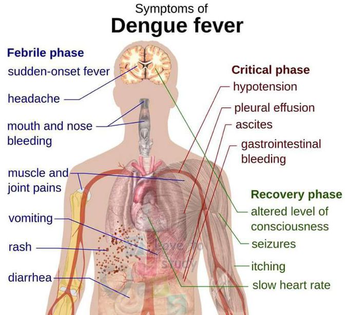 Symptoms of dengue fever