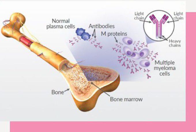 Multiple Myeloma