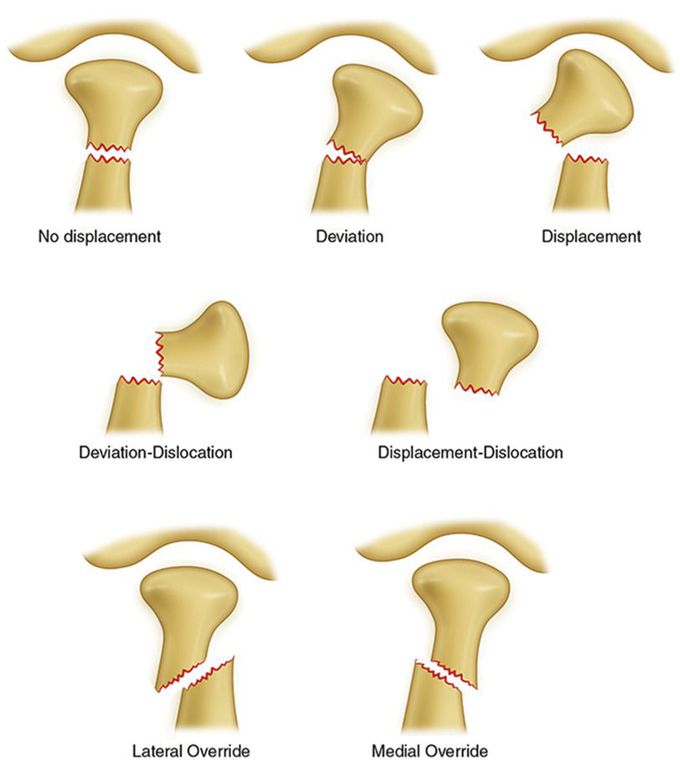 Condylar fracture