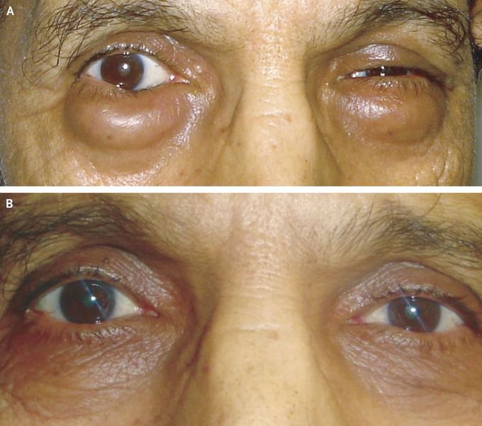 Bilateral Lower Palpebral MALT Lymphoma