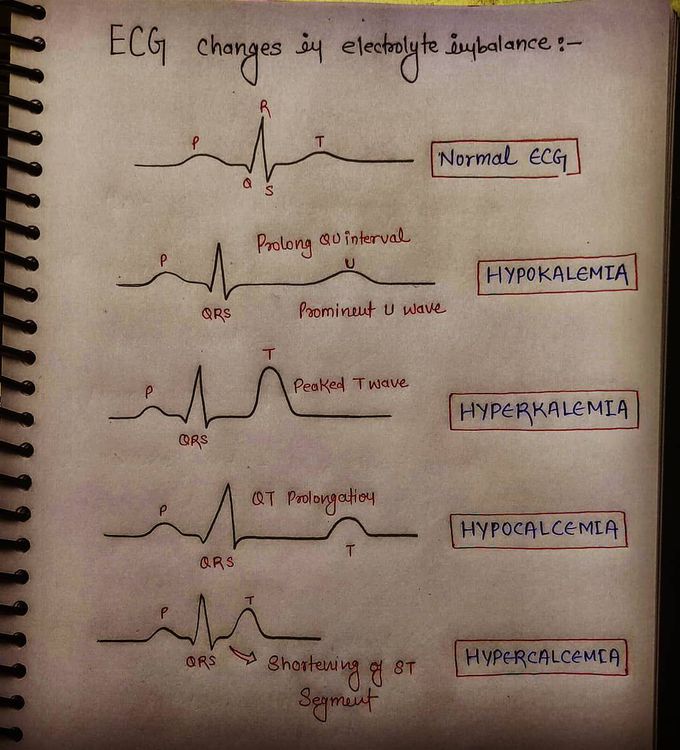 ECG changes in electrolyte imbalance