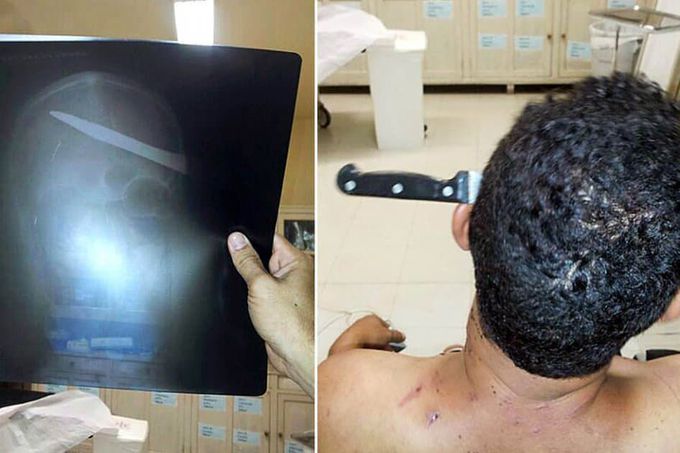 Man with a knife embedded in his head came walking to the hospital! 