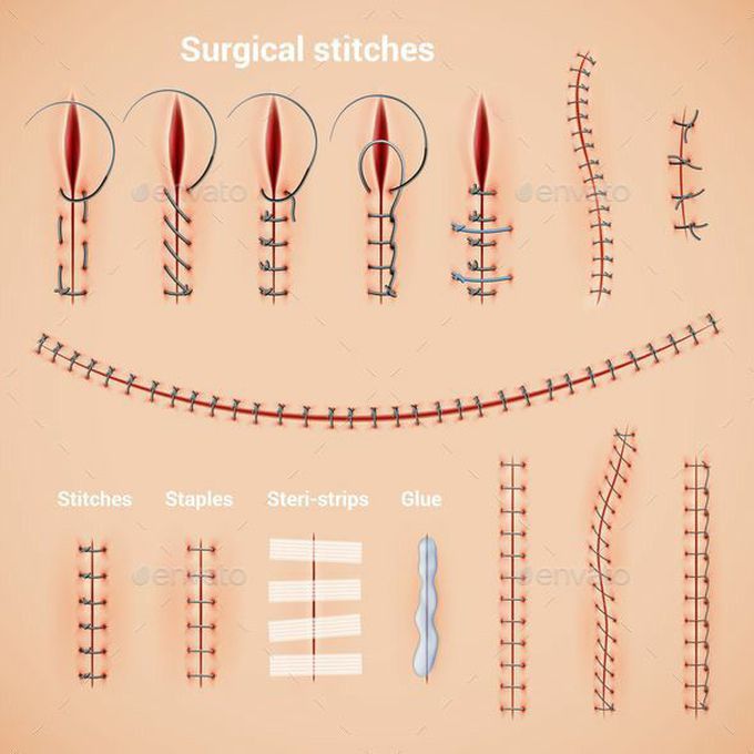 Surgical stitches