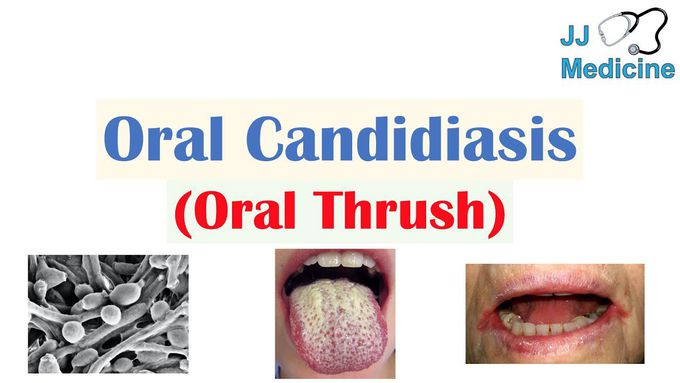 Oral Candidiasis