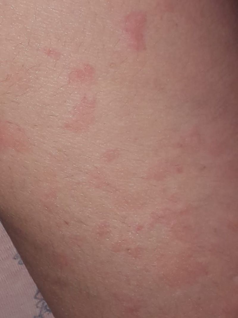 Red papular eruption - MEDizzy