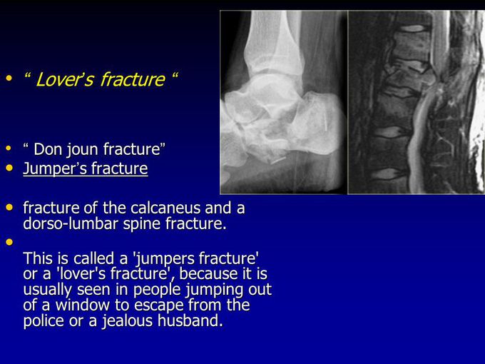 Lover fracture