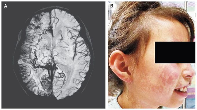 Sturge–Weber Syndrome