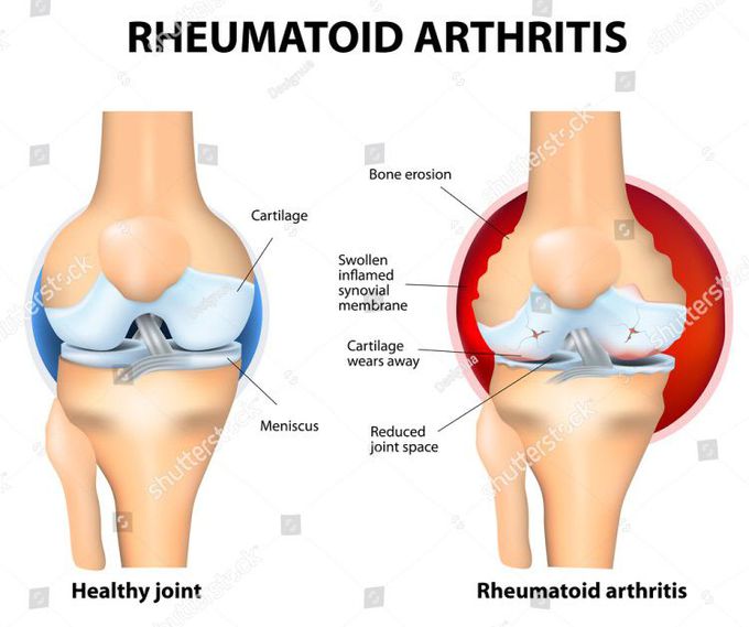 Rheumatoid arthritis