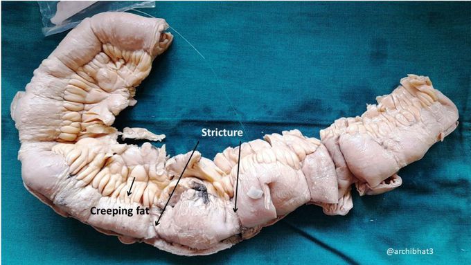 Management of Crohn's Disease