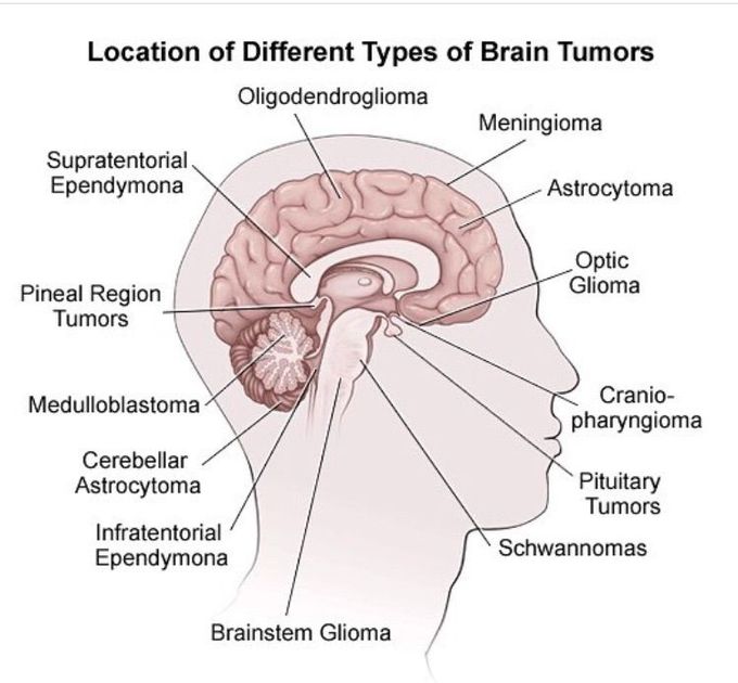 Location of brain tumors