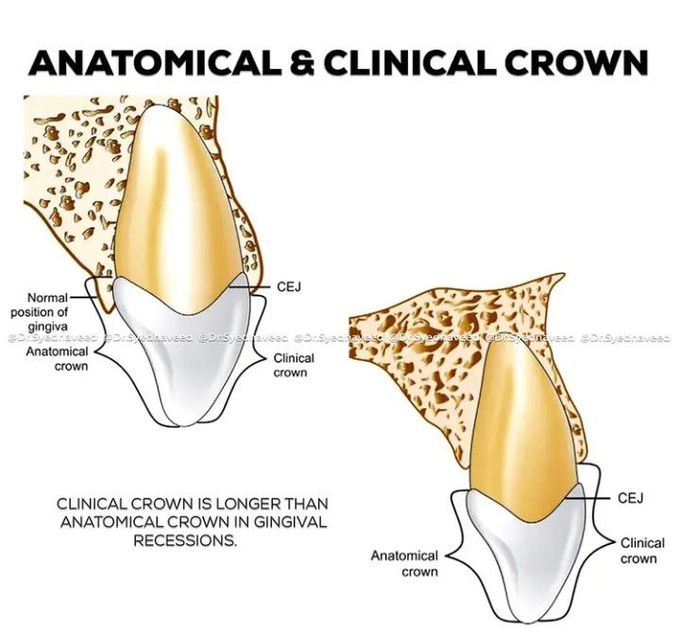Anatomical and Clinical crown of tooth