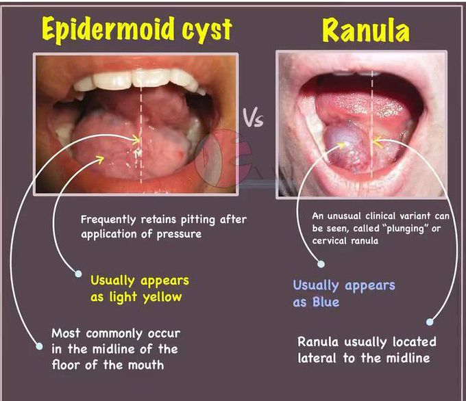 Epidermoid Cyst Vs Ranula