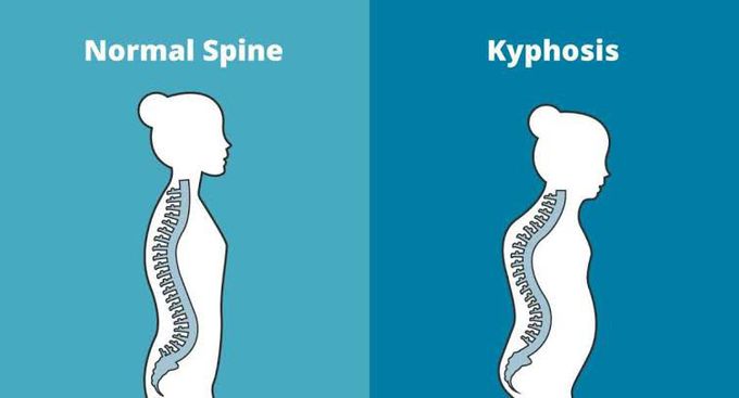Symptoms of kyphosis