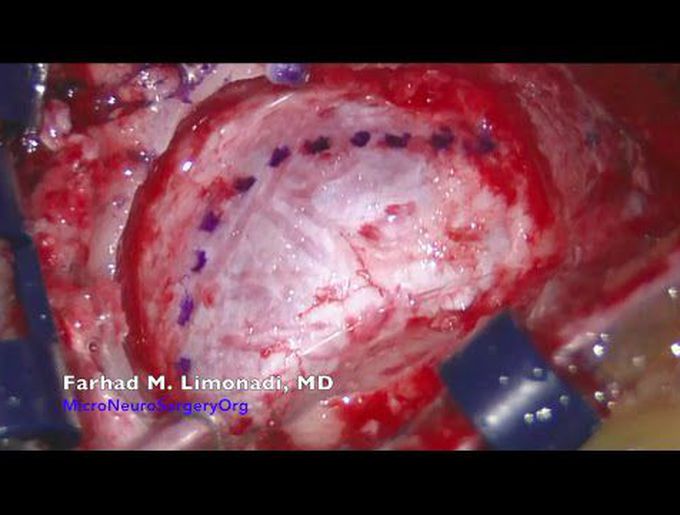 Trigeminal Neuralgia Surgery : Video of surgery for treatment of Trigeminal Neuralgia