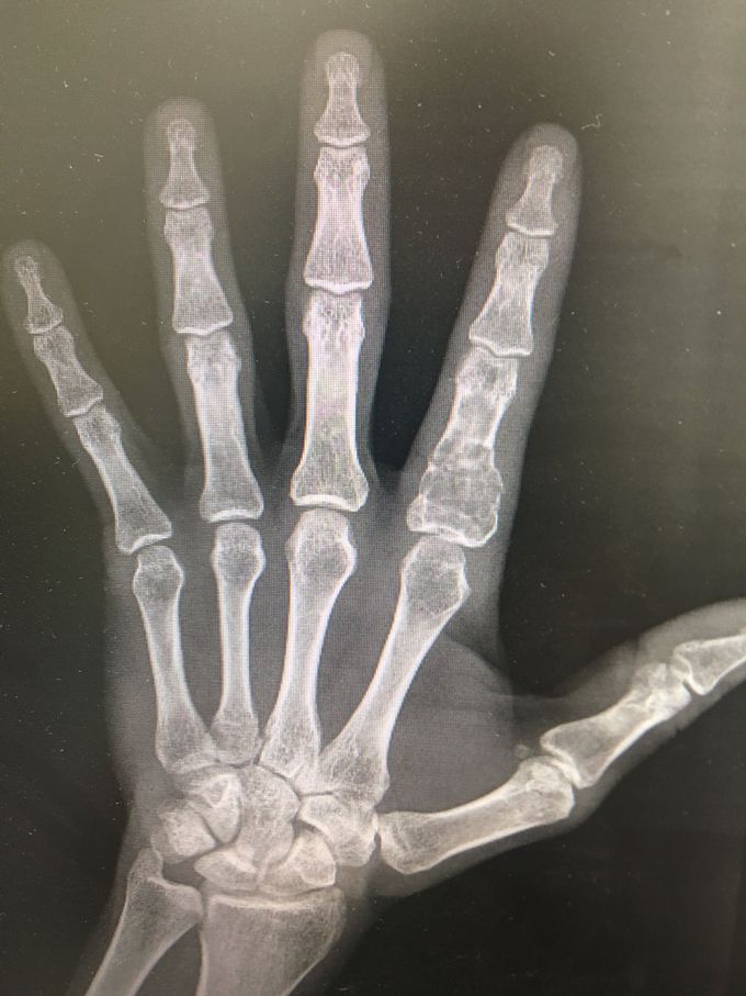 Hand x Ray