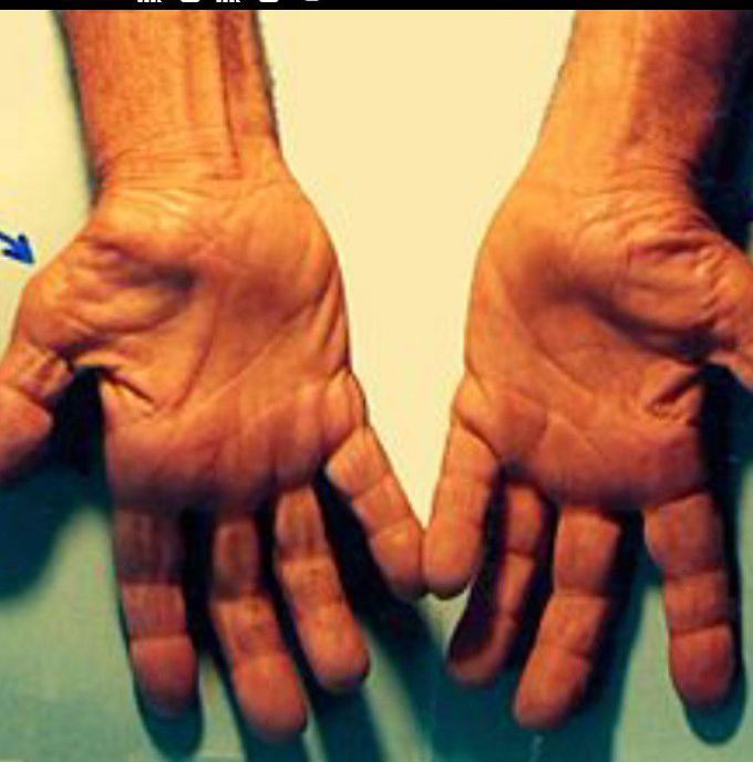 Carpal tunnel syndrome