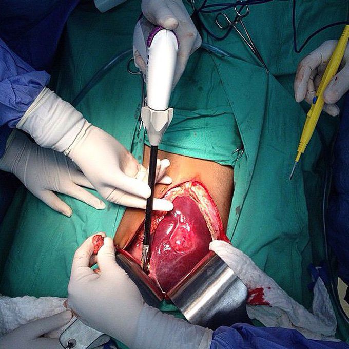 Surgical excision of a liver tumor