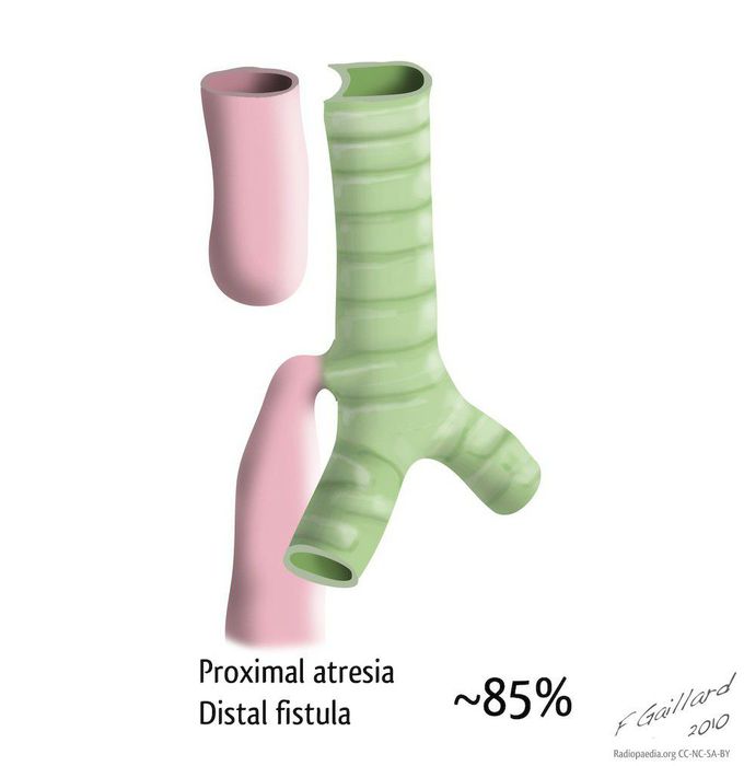 Tracheoesophageal fistula- Connection between trachea and esophagus!