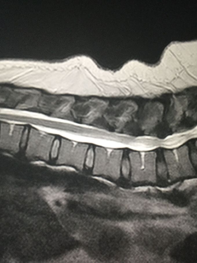 What do you see in this MRI ?