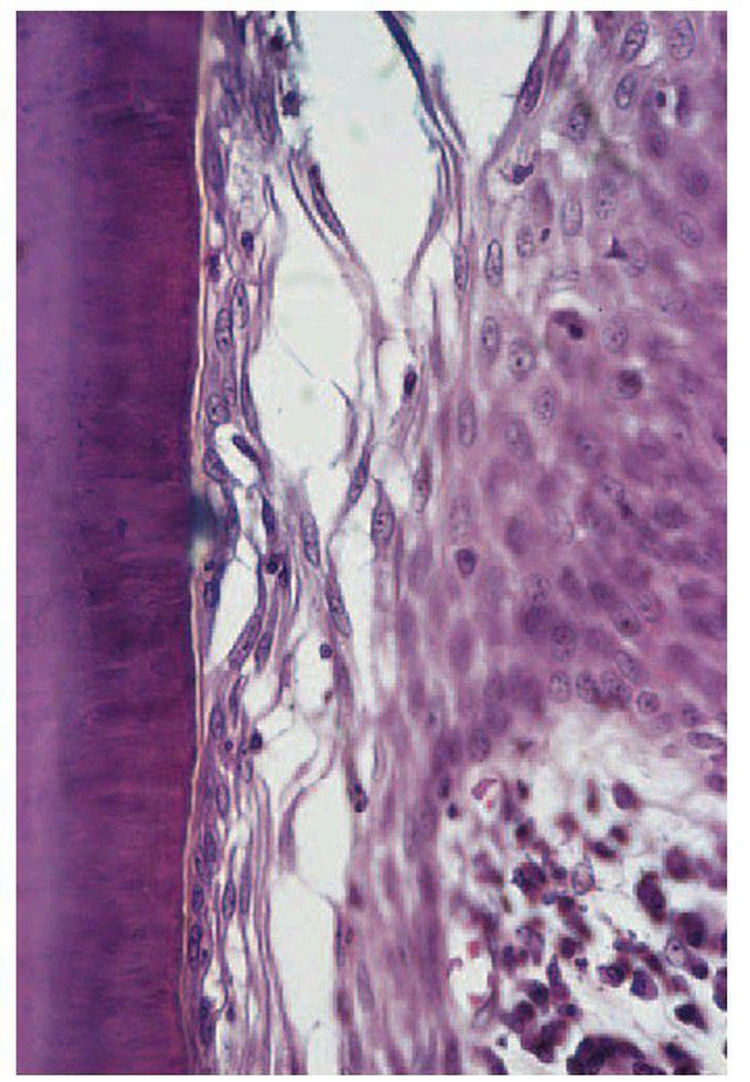 The strength of the epithelial attachment