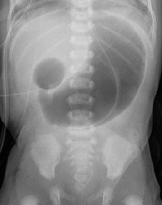 Duodenal Atresia