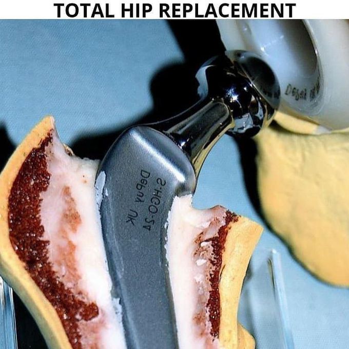 Hip Replacement Surgery