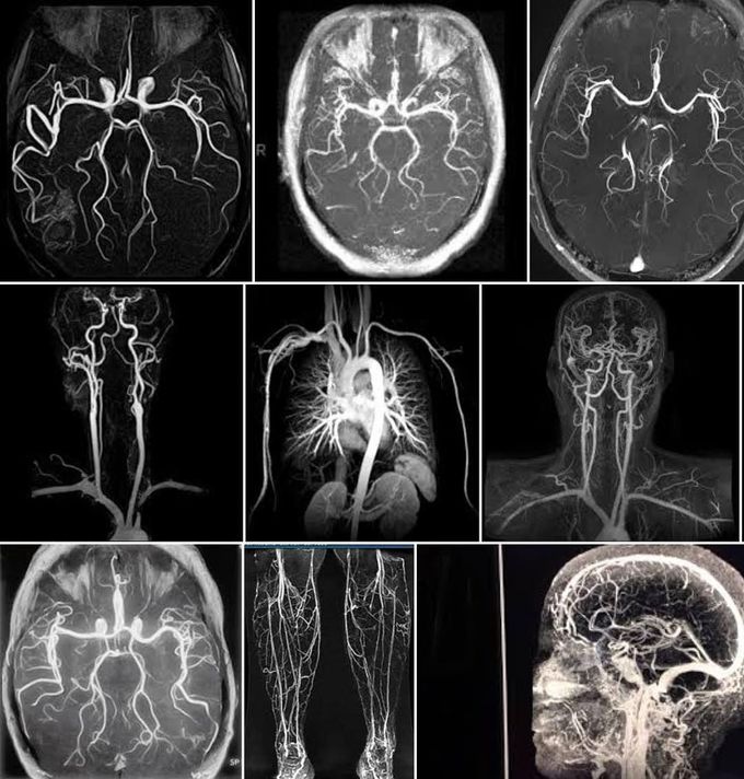 Magnetic Resonance Angiography (MRA)!