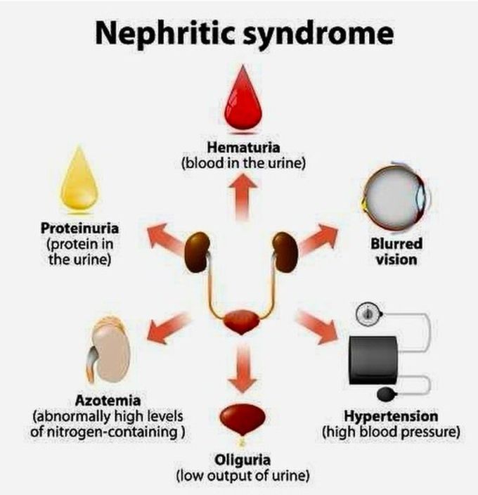 Nephritic Syndrome