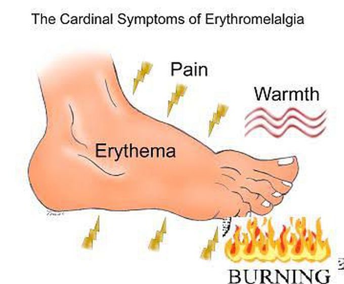 Treatment of burning feet syndrome