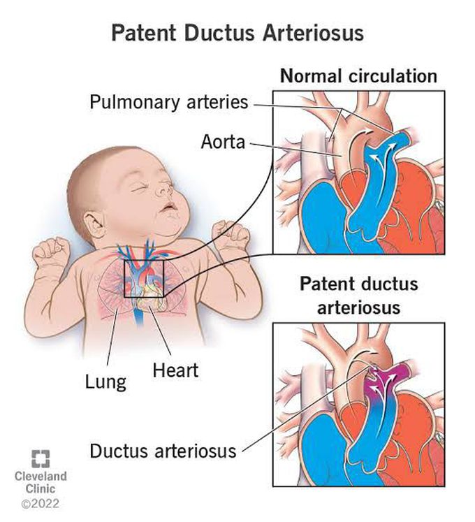 Patent Ductus Arteriosus- Symptoms