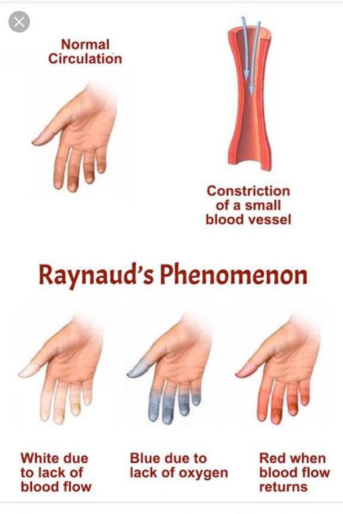 Raynaud's phenomenon