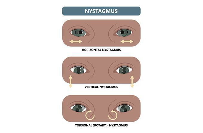 Treatment of nystagmus