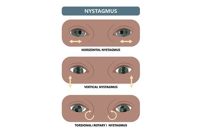 Treatment of nystagmus